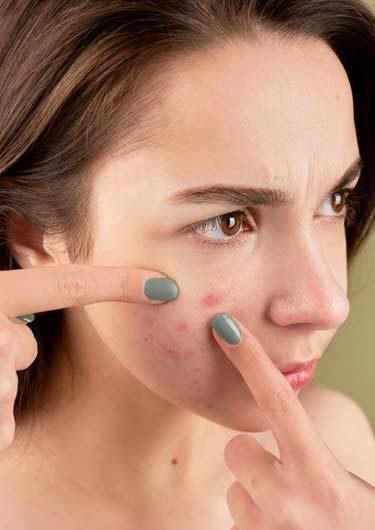 Down with acne
